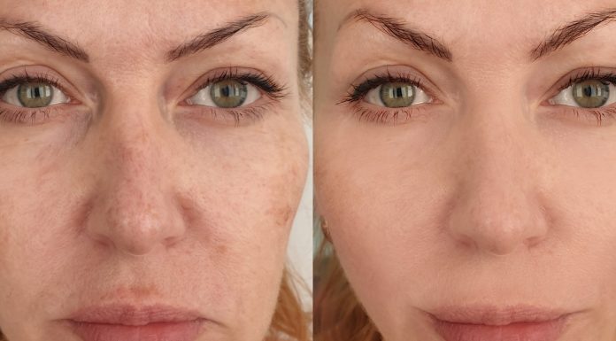 TOP 3 kremy na mocno widoczne przebarwienia. Spektakularne efekty już w 15 dni