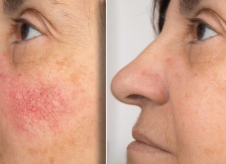 Te kremy łagodzą zaczerwienienia. Pokonają nawet rumień. Zapomnisz o ciężkich korektorach