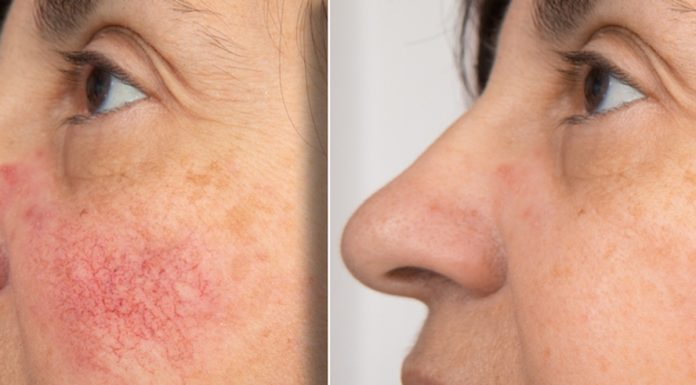 Te kremy łagodzą zaczerwienienia. Pokonają nawet rumień. Zapomnisz o ciężkich korektorach