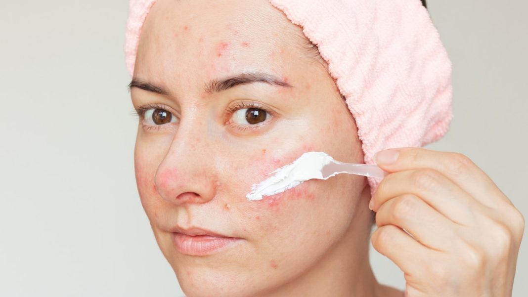 Ta maść to antidotum na trądzik. W aptece kupisz ją za 20 zł