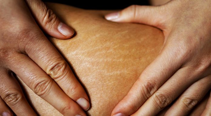 Kultowy balsam na widocznie po odchudzaniu i ciąży rozstępy