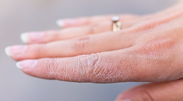 Nawilżasz dłonie i ciągle są suche? Ten krem błyskawicznie pomoże