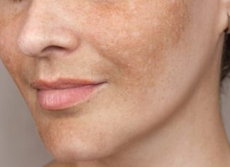 Trzy bestsellerowe sera na przebarwienia. Efektownie rozjaśniają