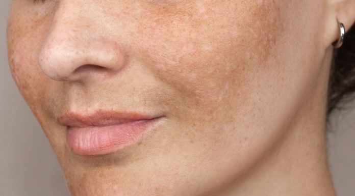 Trzy bestsellerowe sera na przebarwienia. Efektownie rozjaśniają