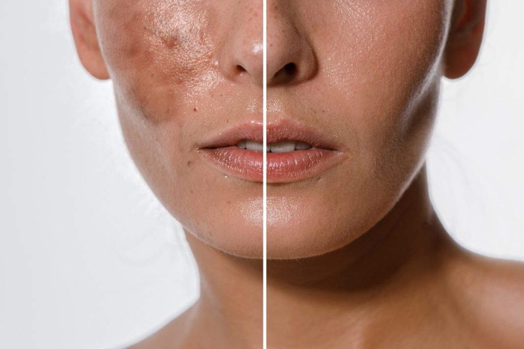 Ten hit w 15 dni zmniejsza nawet mocne przebarwienia.