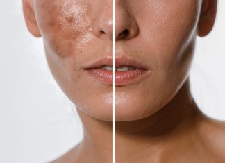 Ten hit w 15 dni zmniejsza nawet mocne przebarwienia. „Pożegnałam brązowe plamy na buzi”