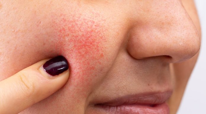 Ten tani krem z olejem z róży stulistnej wzmacnia naczynka i redukuje „pajączki”