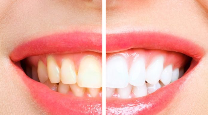 Ta wybielająca pasta powstała specjalnie z myślą o palaczach. „Odzyskałam biały uśmiech!”