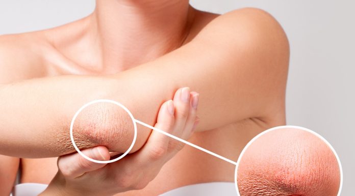 Te bogate kremy uporają się z suchymi łokciami. Zapomnij o dyskomforcie