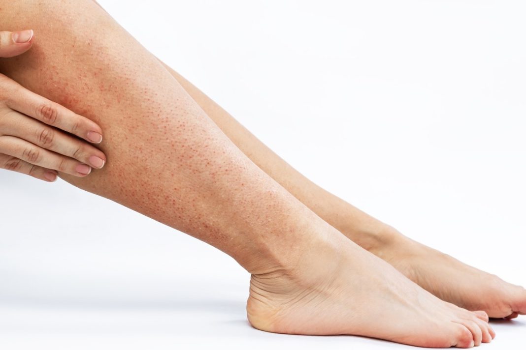 Truskawkowe nogi? Ten enzymatyczny balsam 2w1 usunie krostki i plamki