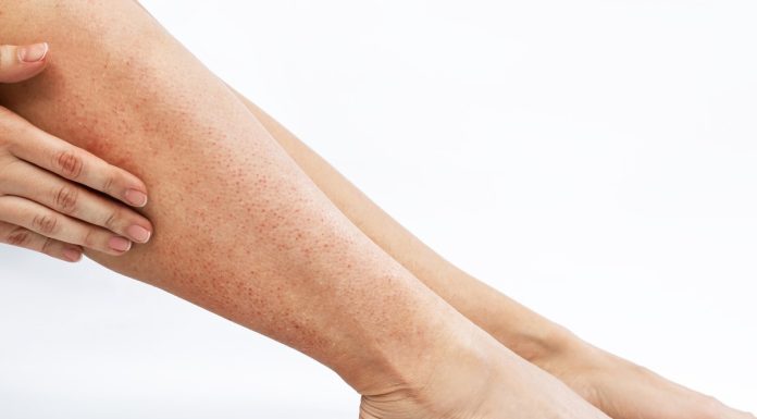 Truskawkowe nogi? Ten enzymatyczny balsam 2w1 usunie krostki i plamki