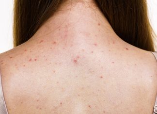 Trzy kosmetyki, które pomogą pozbyć się śladów po trądziku na plecach. Przywróć skórze gładkość