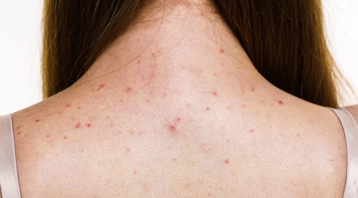Trzy kosmetyki, które pomogą pozbyć się śladów po trądziku na plecach. Przywróć skórze gładkość