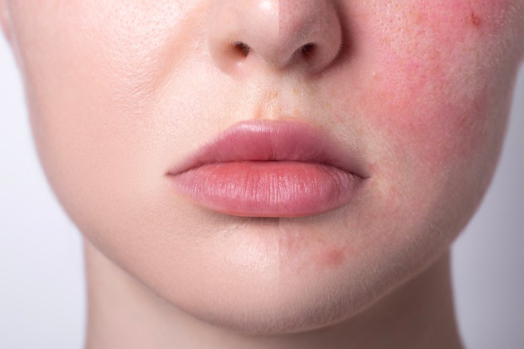 Te dermokosmetyki natychmiast redukują zaczerwienienia i wzmacniają naczynka. Kobiety z cerą naczynkową je pokochają