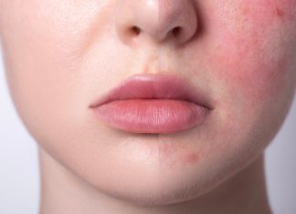 Te dermokosmetyki natychmiast redukują zaczerwienienia i wzmacniają naczynka. Kobiety z cerą naczynkową je pokochają