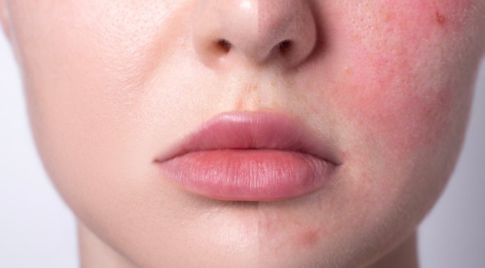 Te dermokosmetyki natychmiast redukują zaczerwienienia i wzmacniają naczynka. Kobiety z cerą naczynkową je pokochają