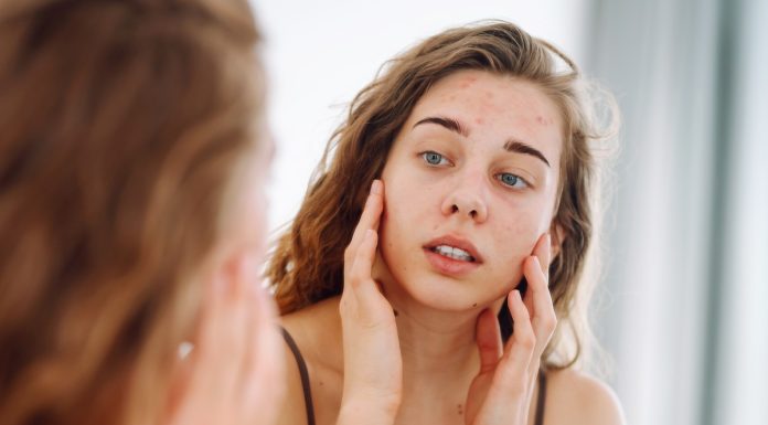 Masz wypryski na twarzy mimo odpowiedniej pielęgnacji? Powód może być błahy