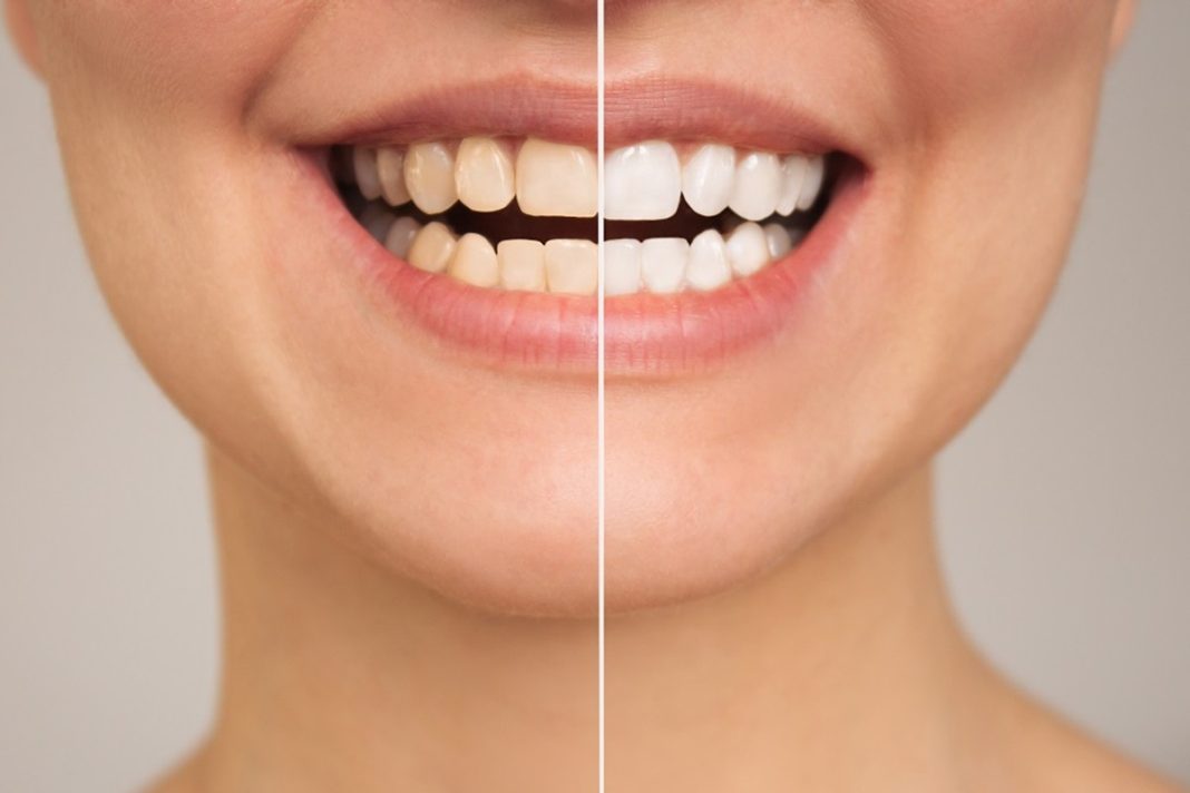 Usuwa przebarwienia, kamień nazębny i nieświeży oddech. Ta pasta pomoże odbudować szkliwo