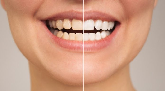 Usuwa przebarwienia, kamień nazębny i nieświeży oddech. Ta pasta pomoże odbudować szkliwo