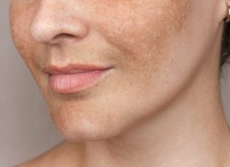 Witamina C to pogromca przebarwień. To dzięki niej te sera są tak skuteczne