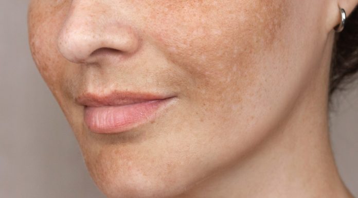 Witamina C to pogromca przebarwień. To dzięki niej te sera są tak skuteczne