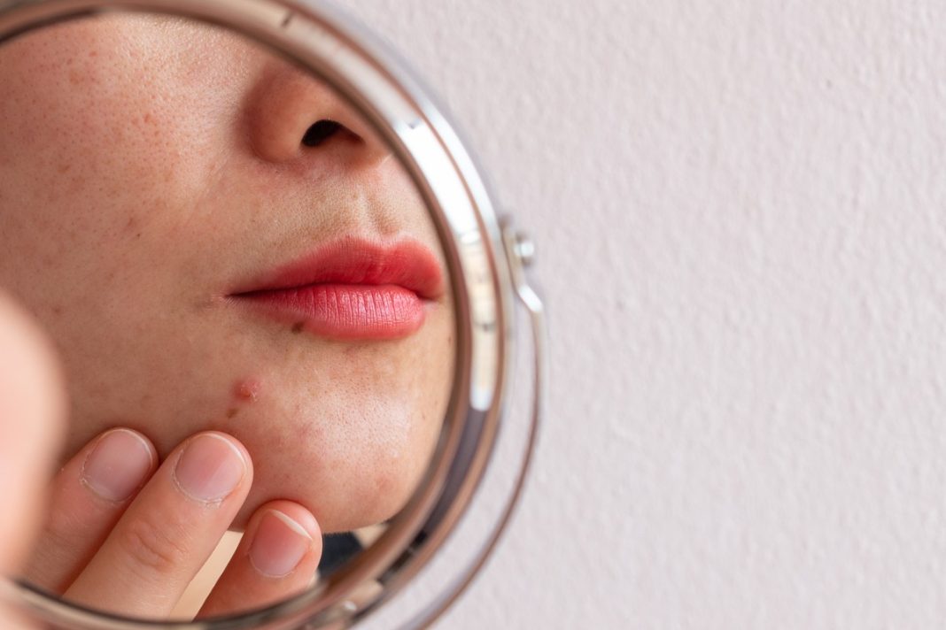 Ten kwasowy koncentrat punktowy 2w1 zmiata pryszcze w jedną noc