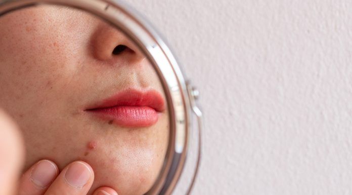 Ten kwasowy koncentrat punktowy 2w1 zmiata pryszcze w jedną noc