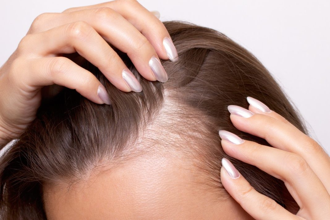 Włosy wypadają ci garściami? Oto TOP 3 szampony, które pomogą nawet na widoczne zakola