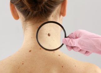 Lekarz zauważył pieprzyk, który wydał mu się podejrzany. Myślałam: jak mogłam go nie zauważyć