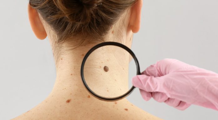 Lekarz zauważył pieprzyk, który wydał mu się podejrzany. Myślałam: jak mogłam go nie zauważyć