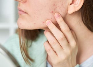 Maść za 5 zł, która oczyści cerę w jedną noc. Hit wśród Polek