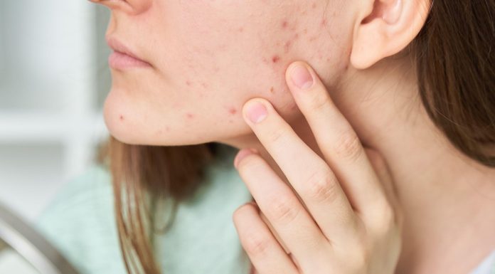 Maść za 5 zł, która oczyści cerę w jedną noc. Hit wśród Polek