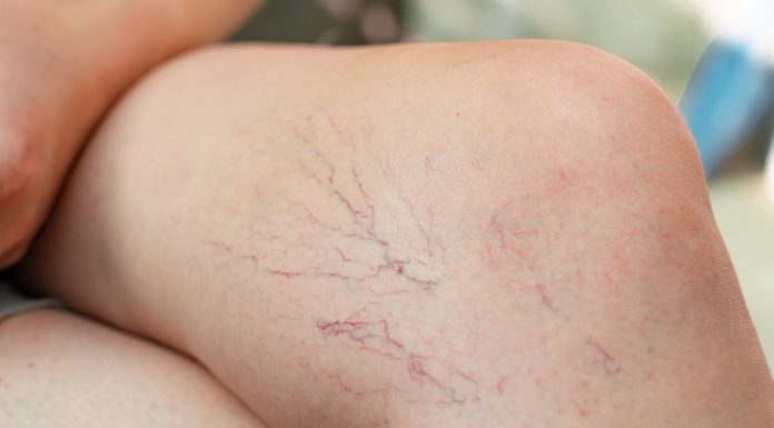 Trzy preparaty, które zmniejszą widoczność pajączków na nogach