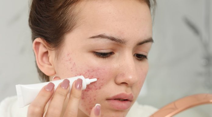 Delikatna cera z trądzikiem różowatym? Oto kosmetyki, które pomogą ją ukoić