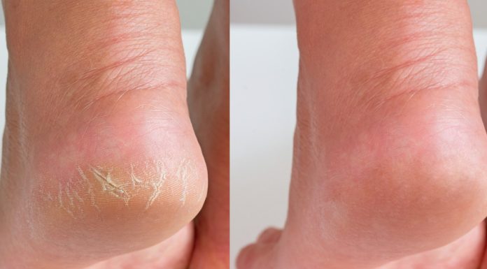 Te kremy do stóp mają wysokie stężenie mocznika. Wygładzają nawet bardzo szorstkie pięty