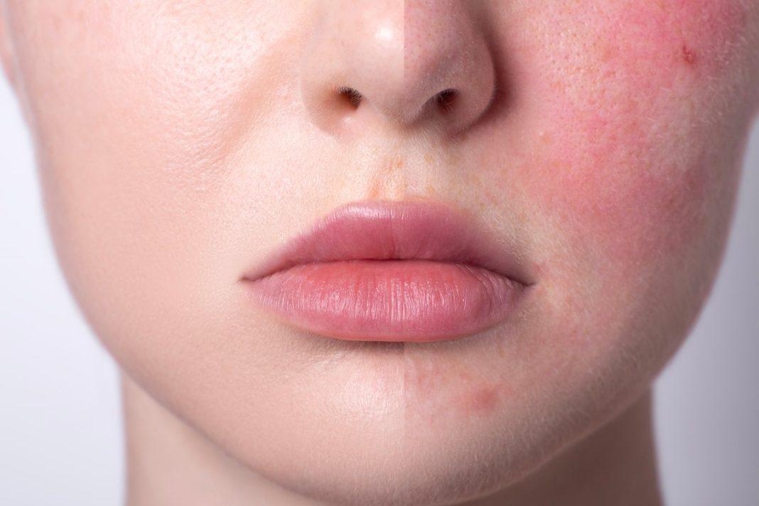 To tanie serum niweluje zaczerwienienia w 15 minut. Działa jak kojący zabieg SOS