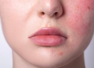 To tanie serum niweluje zaczerwienienia w 15 minut. Działa jak kojący zabieg SOS