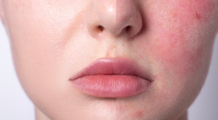 To tanie serum niweluje zaczerwienienia w 15 minut. Działa jak kojący zabieg SOS