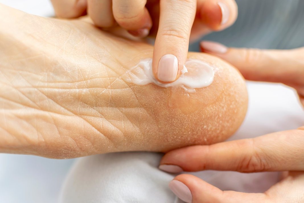 Bogata maść na pęknięcia to ratunek dla pięt. Ma olejek z rozmarynu