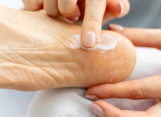 Bogata maść na pęknięcia to ratunek dla pięt. Ma olejek z rozmarynu