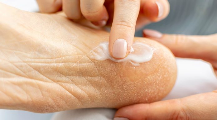 Bogata maść na pęknięcia to ratunek dla pięt. Ma olejek z rozmarynu