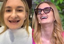 Zrobiła sobie „tureckie zęby”. Dentyści łapią się za głowę